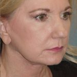 Thumbnail photo of the patient’s after the Facelift Patient 3
