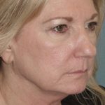 Thumbnail photo of the patient’s before the Facelift Patient 3