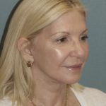 Thumbnail photo of the patient’s after the Facelift Patient 4