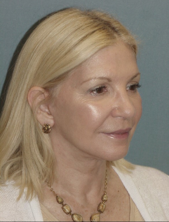 Photo of the patient’s after the Facelift Patient 4