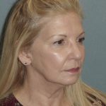 Thumbnail photo of the patient’s before the Facelift Patient 4