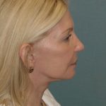 Thumbnail photo of the patient’s after the Facelift Patient 4