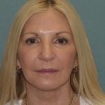 Thumbnail photo of the patient’s after the Facelift Patient 4