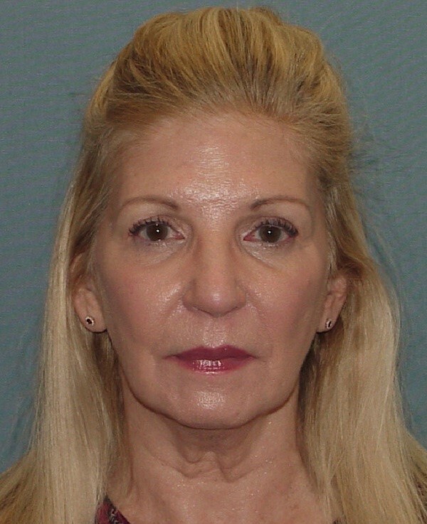 Photo of the patient’s before the Facelift Patient 4