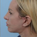 Thumbnail photo of the patient’s after the Facelift Patient 6