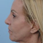 Thumbnail photo of the patient’s before the Facelift Patient 6