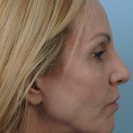 Thumbnail photo of the patient’s before the Facelift Patient 6