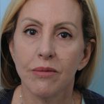 Thumbnail photo of the patient’s after the Facelift Patient 6