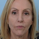 Thumbnail photo of the patient’s before the Facelift Patient 6