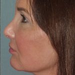 Thumbnail photo of the patient’s after the Facelift Patient 7
