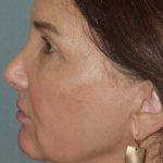 Thumbnail photo of the patient’s before the Facelift Patient 7