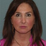 Thumbnail photo of the patient’s after the Facelift Patient 7