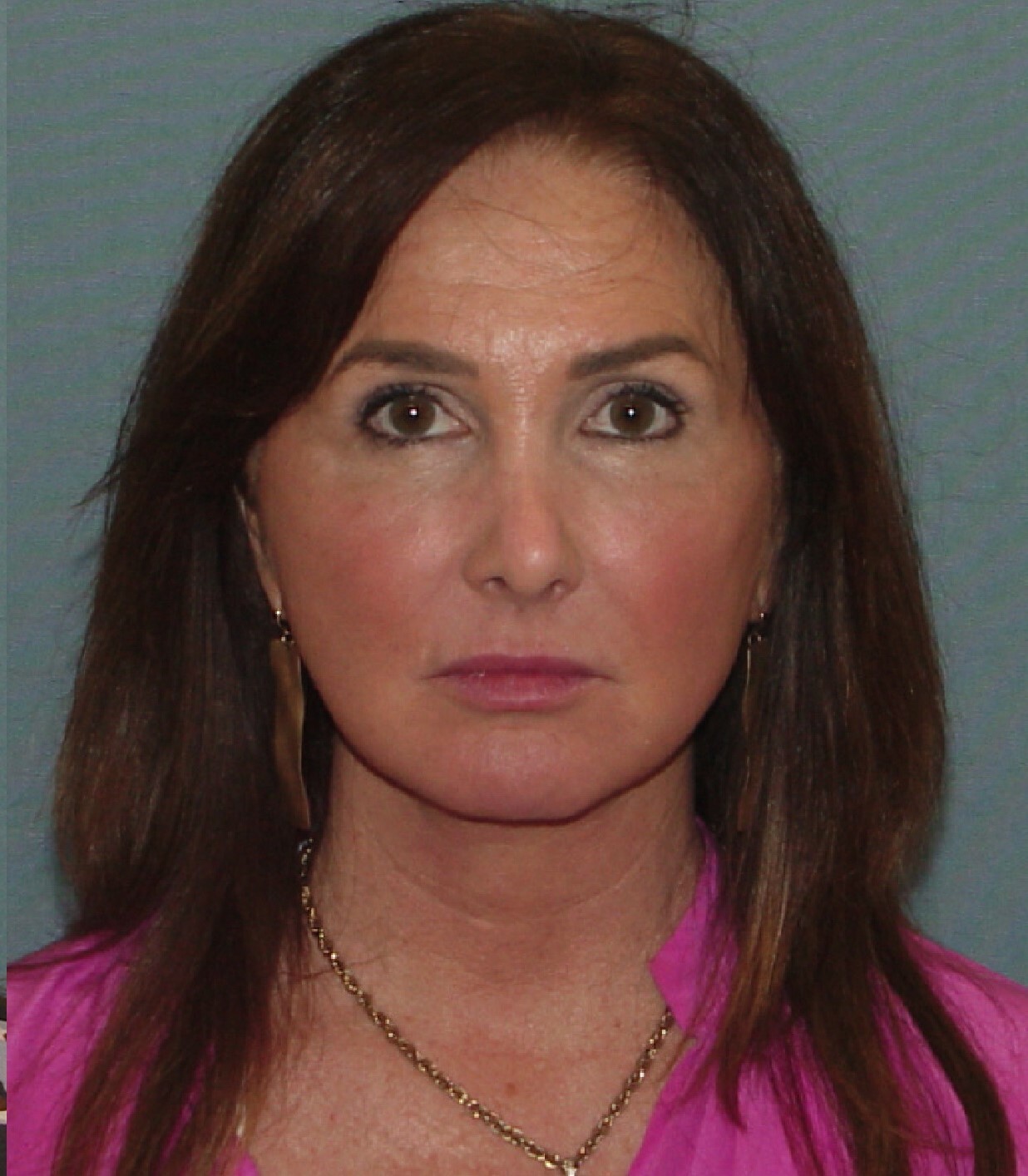 Photo of the patient’s after the Facelift Patient 7