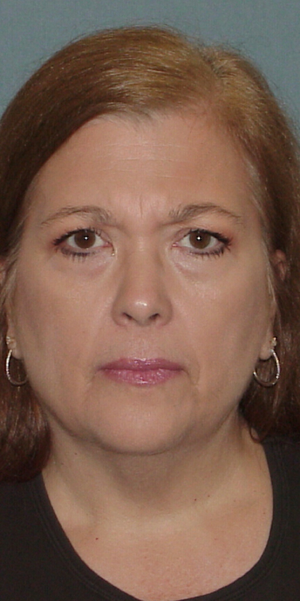Photo of the patient’s face before the Facelift surgery. Set 1. Patient 2