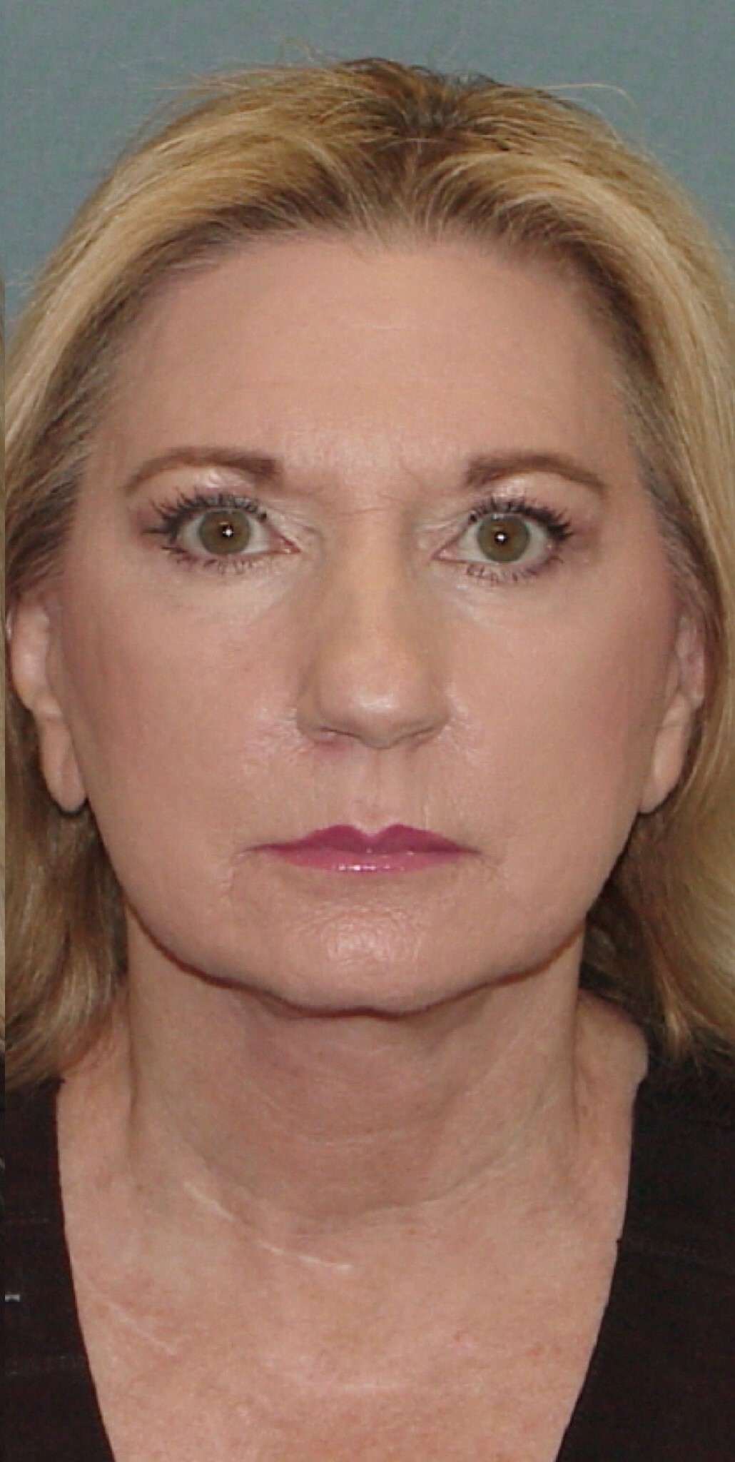 Photo of the patient’s face after the Facelift surgery. Set 1. Patient 3