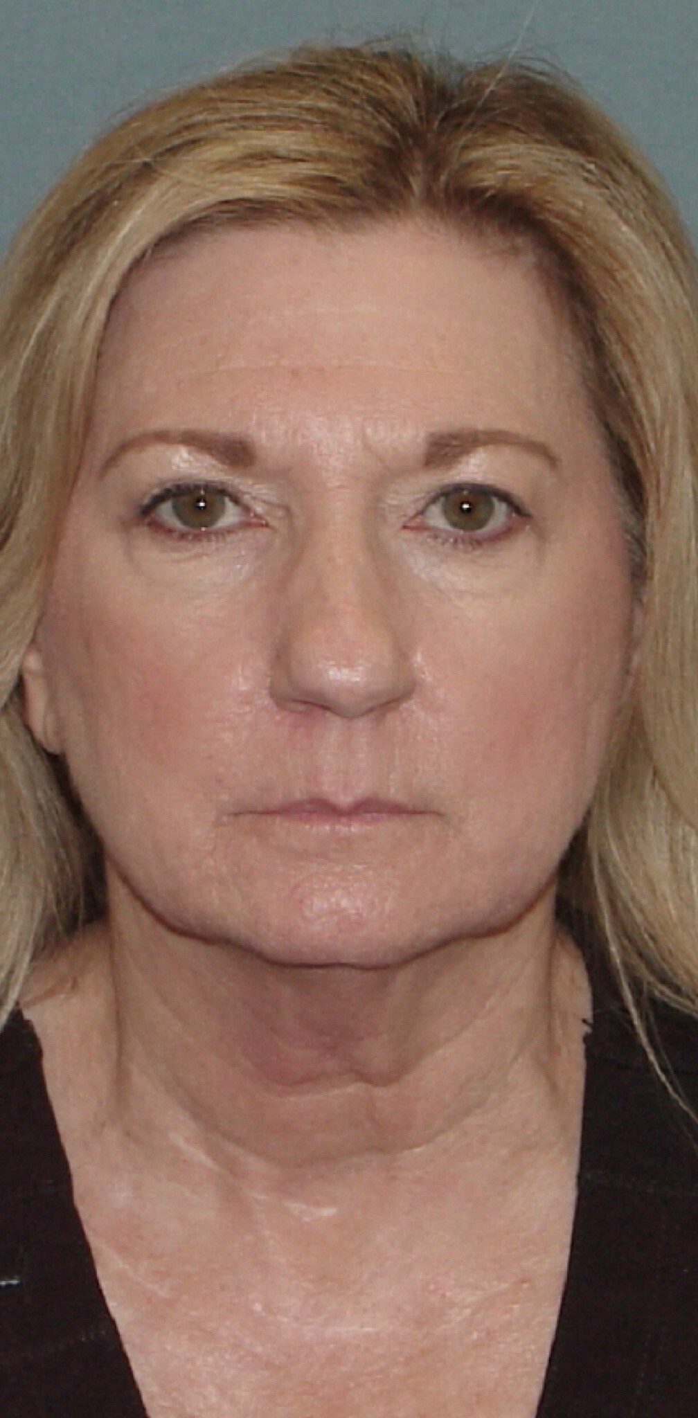Photo of the patient’s face before the Facelift surgery. Set 1. Patient 3