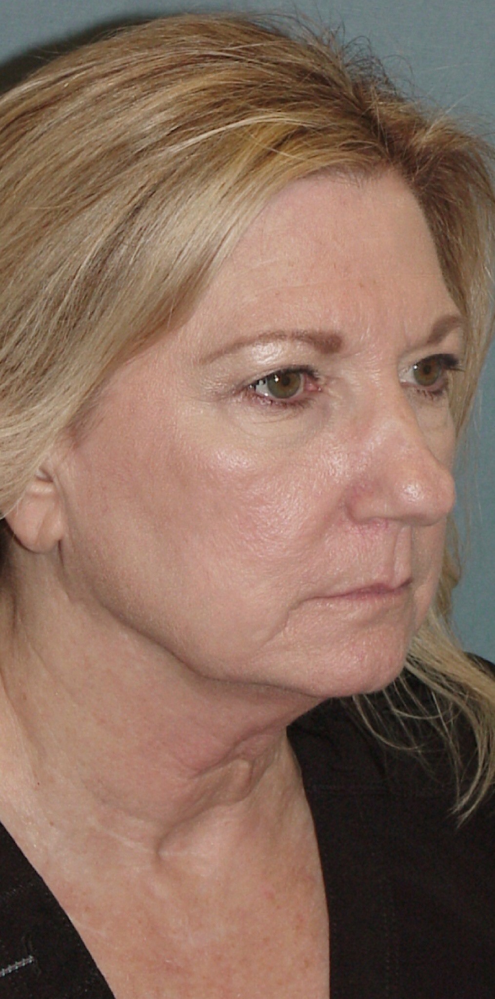 Photo of the patient’s face before the Facelift surgery. Set 2. Patient 3
