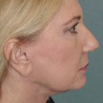 Photo of the patient’s face after the Facelift surgery. Set 3. Patient 3