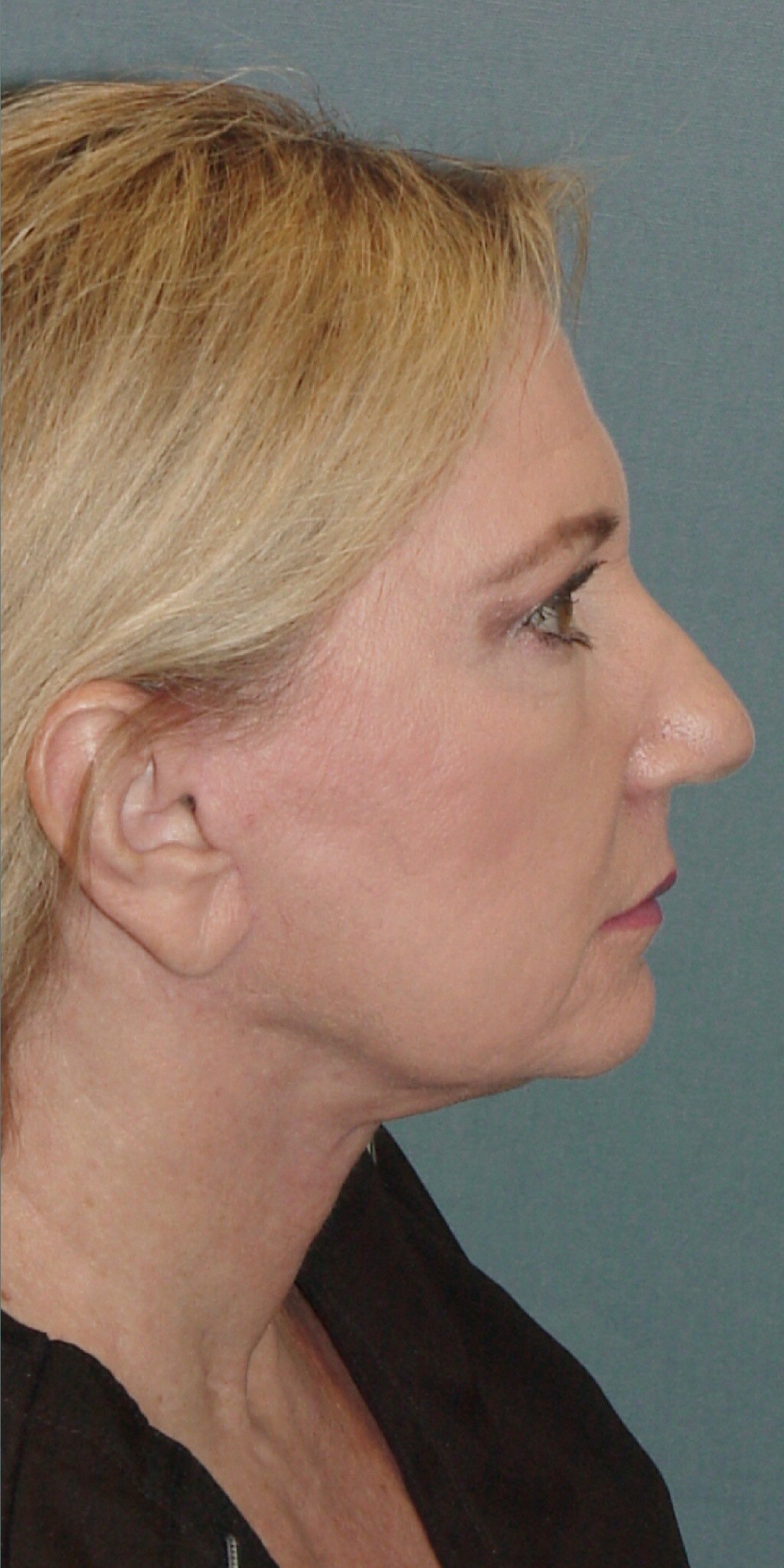 Photo of the patient’s face after the Facelift surgery. Set 3. Patient 3