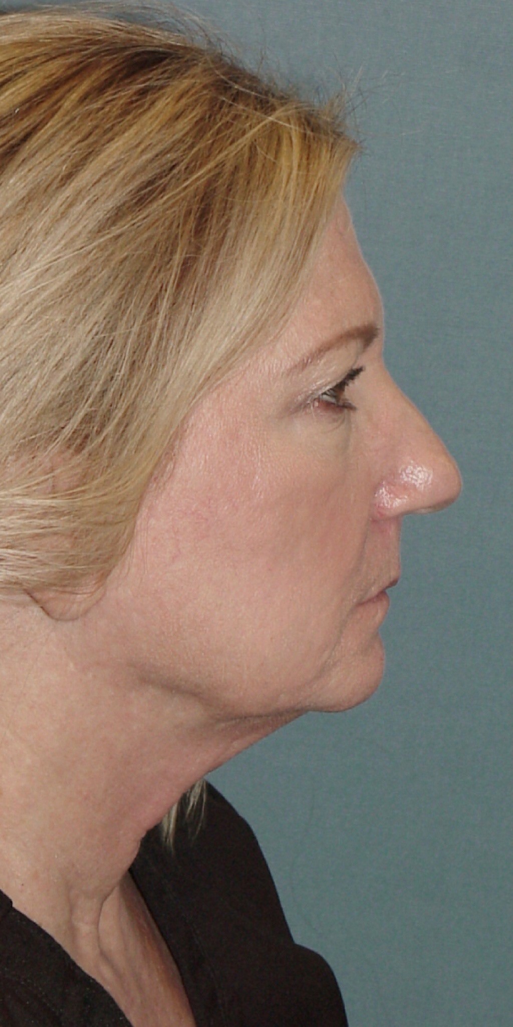 Photo of the patient’s face before the Facelift surgery. Set 3. Patient 3