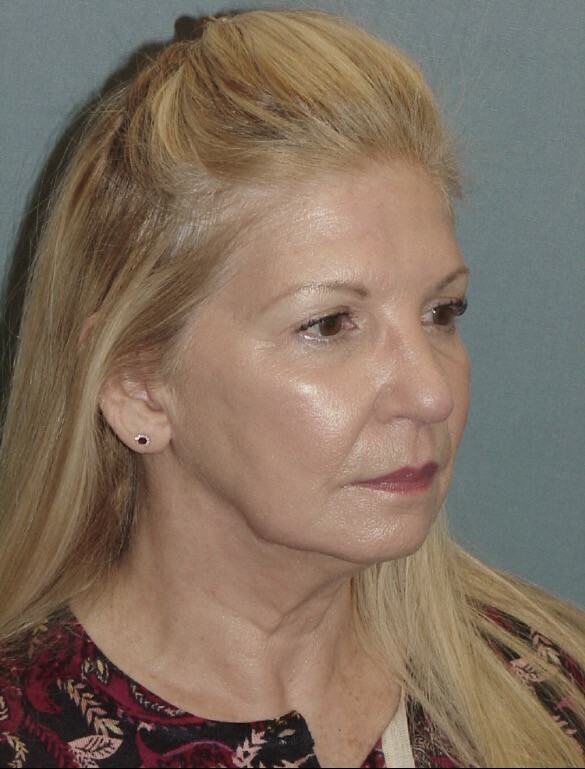 Photo of the patient’s face before the Facelift surgery. Set 2. Patient 4