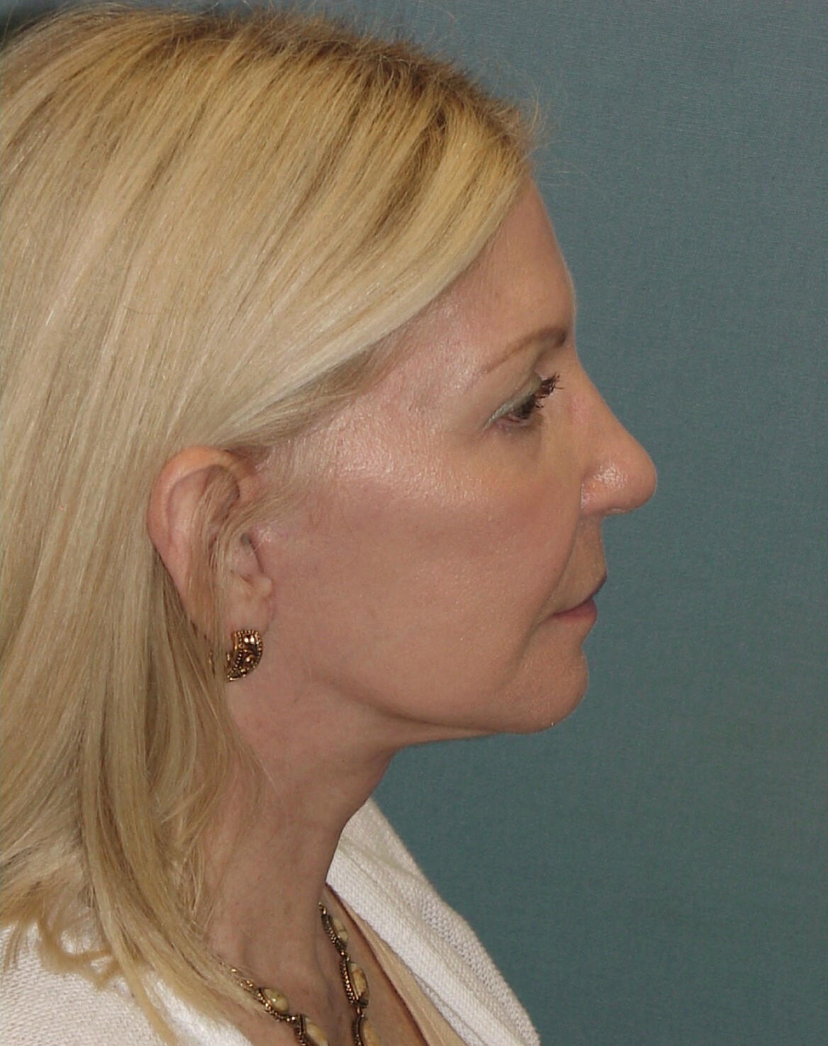 Photo of the patient’s face after the Facelift surgery. Set 3. Patient 4