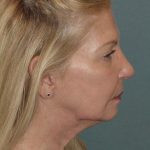 Photo of the patient’s face before the Facelift surgery. Set 3. Patient 4