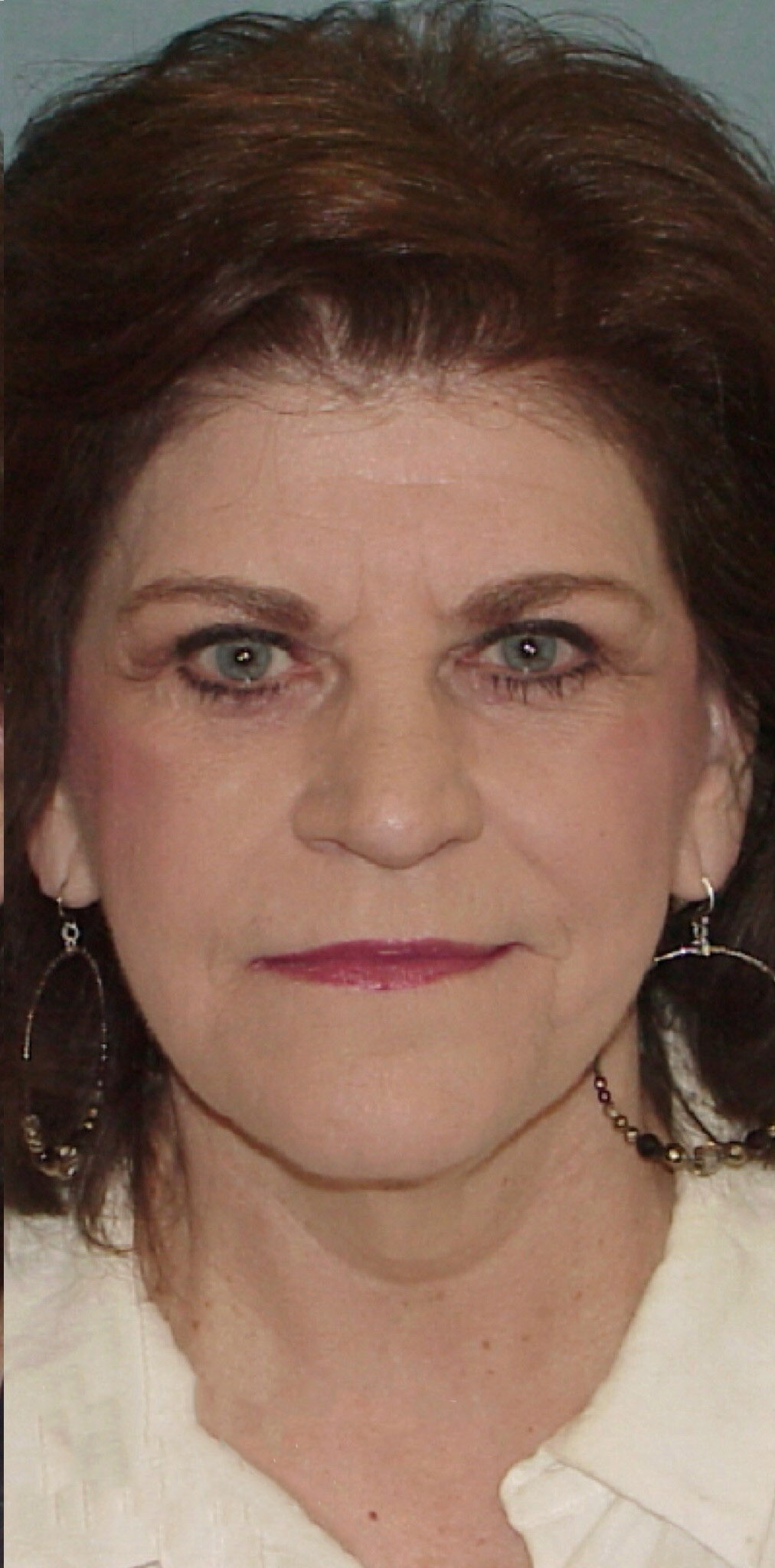 Photo of the patient’s after the Facelift Patient 5