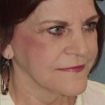 Thumbnail photo of the patient’s after the Facelift Patient 5