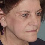 Thumbnail photo of the patient’s before the Facelift Patient 5