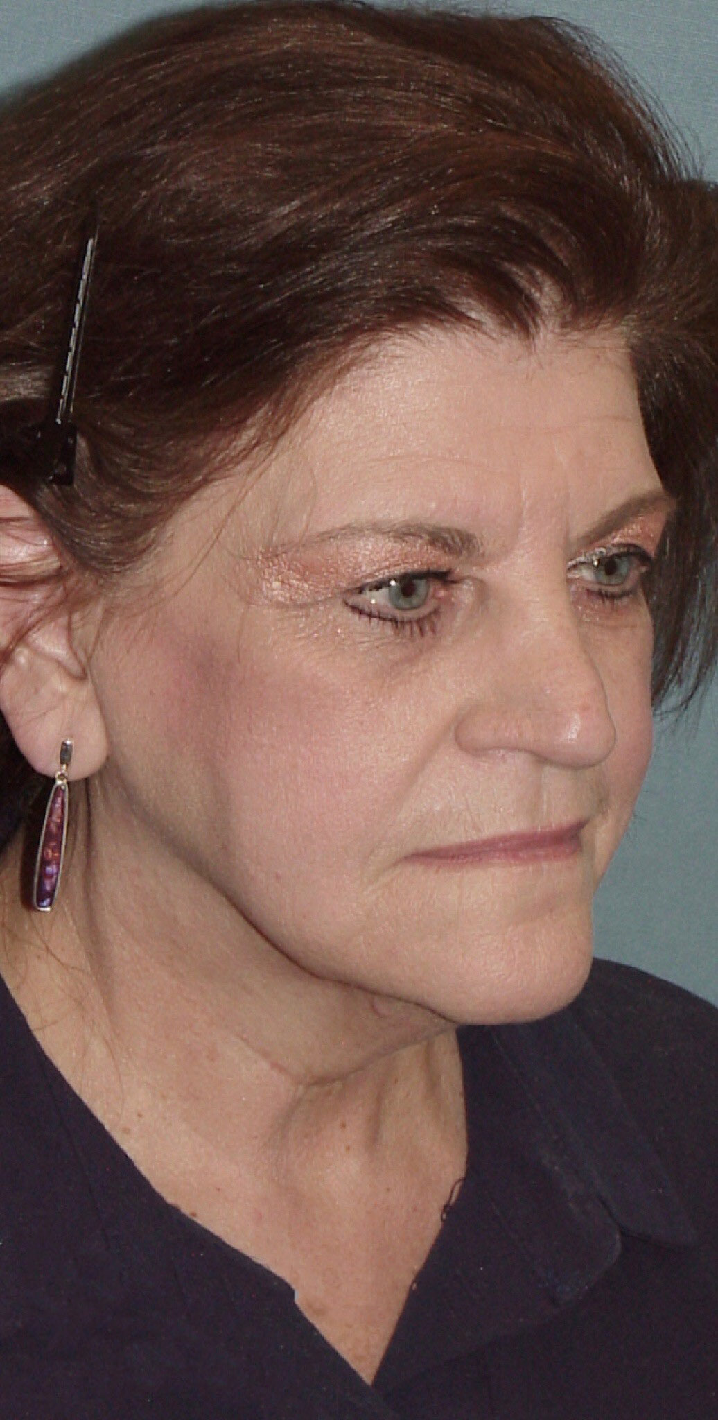 Photo of the patient’s before the Facelift Patient 5