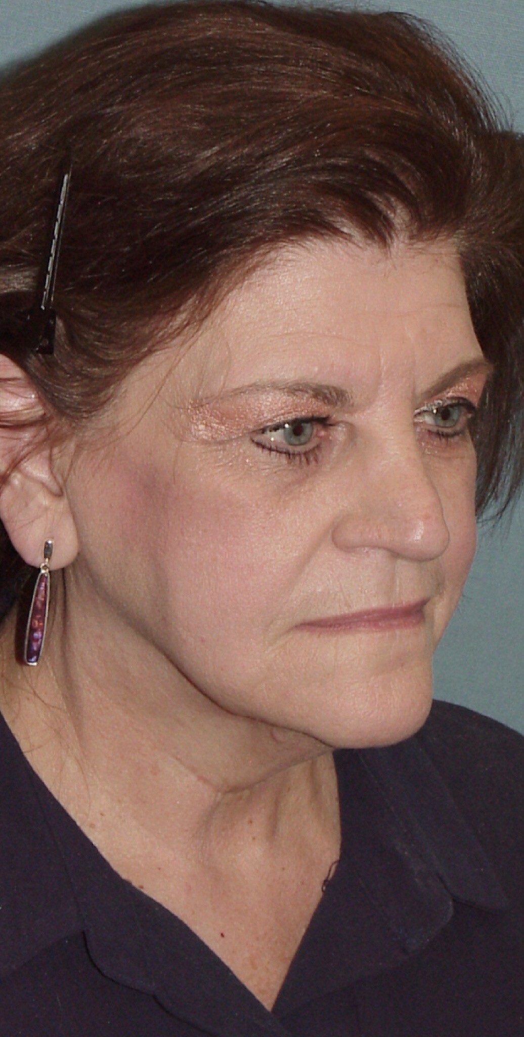 Photo of the patient’s face before the Facelift surgery. Set 2. Patient 5