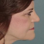 Thumbnail photo of the patient’s after the Facelift Patient 5