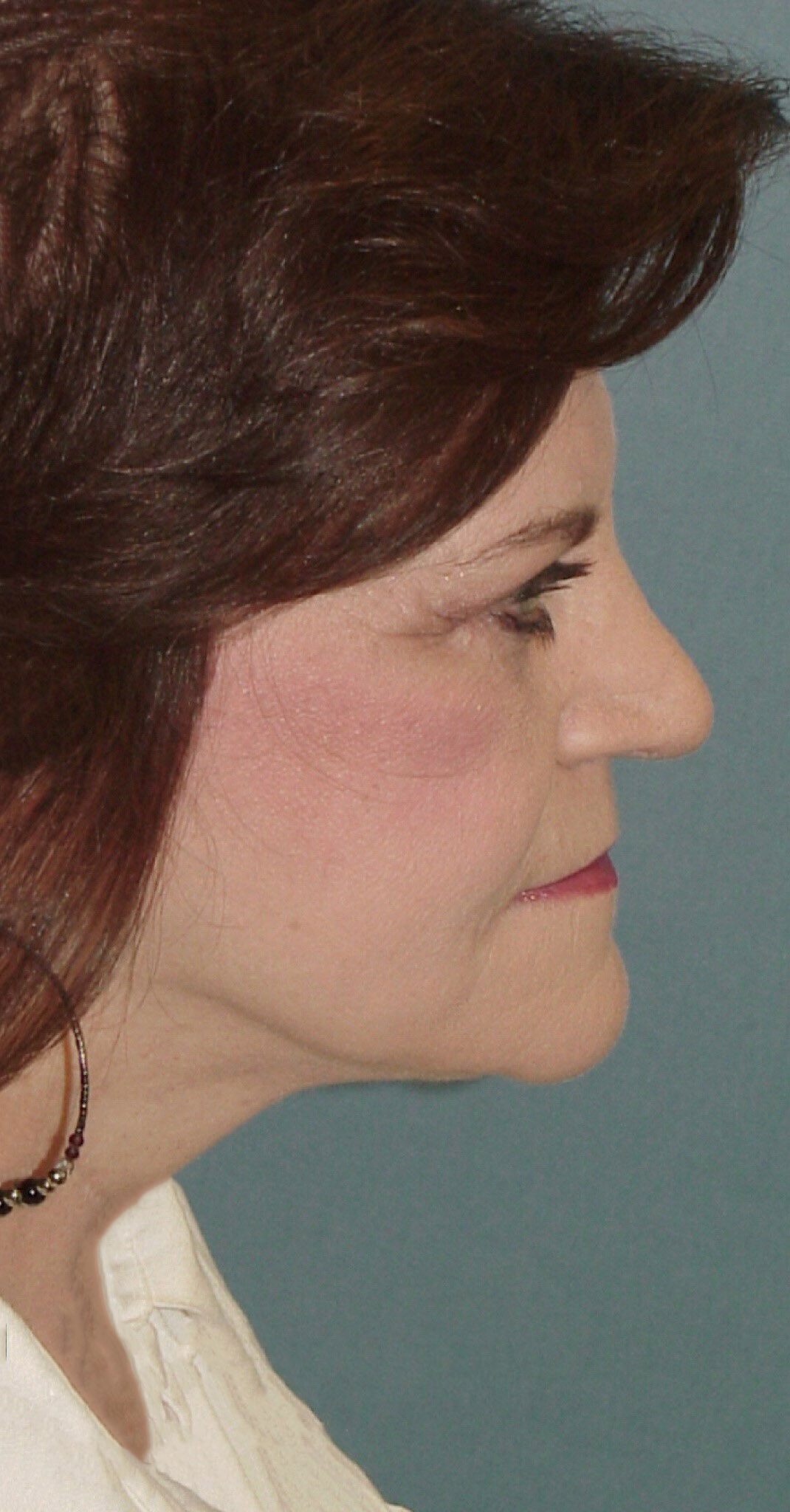 Photo of the patient’s after the Facelift Patient 5