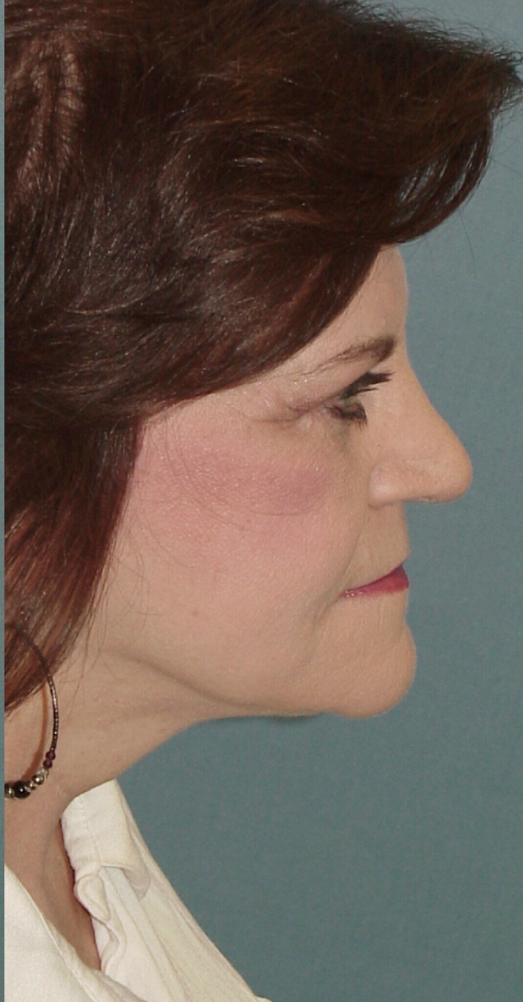 Photo of the patient’s face after the Facelift surgery. Set 3. Patient 5