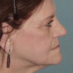 Thumbnail photo of the patient’s before the Facelift Patient 5