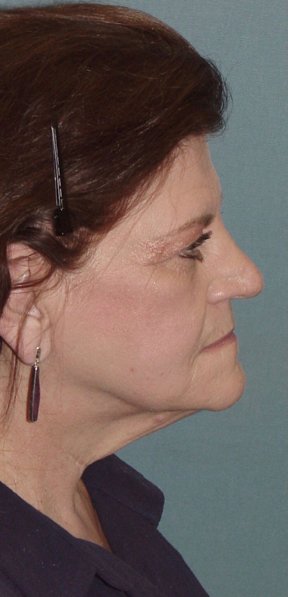 Photo of the patient’s face before the Facelift surgery. Set 3. Patient 5