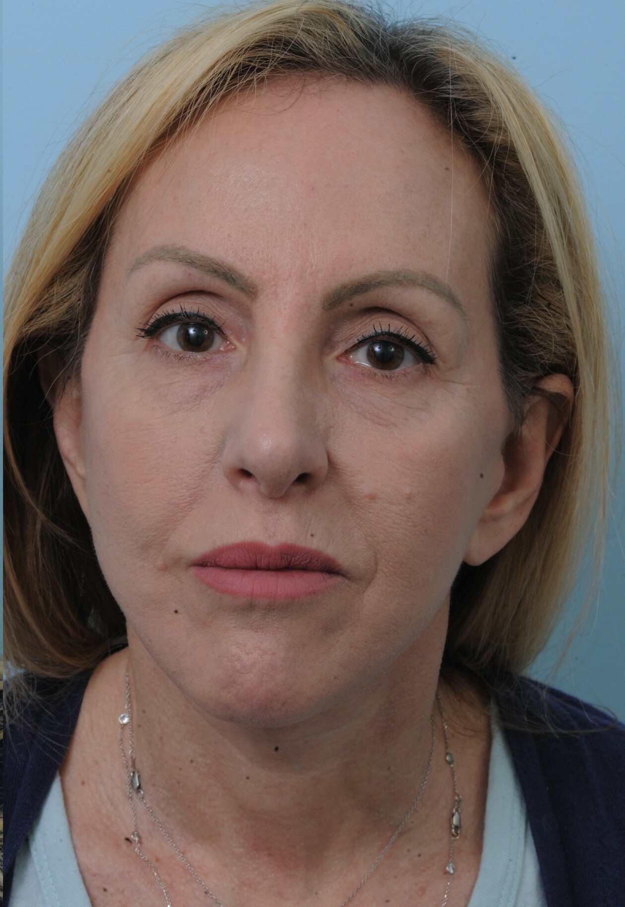 Photo of the patient’s face after the Facelift surgery. Set 1. Patient 6