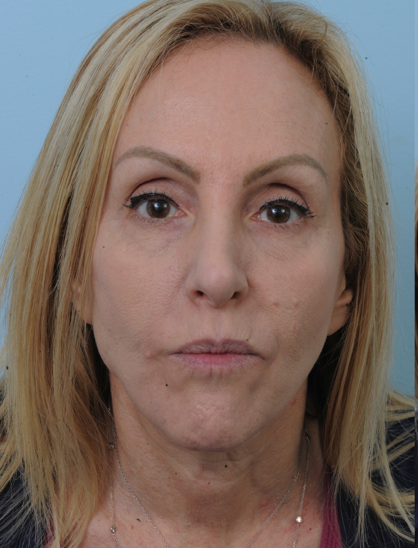 Photo of the patient’s face before the Facelift surgery. Set 1. Patient 6