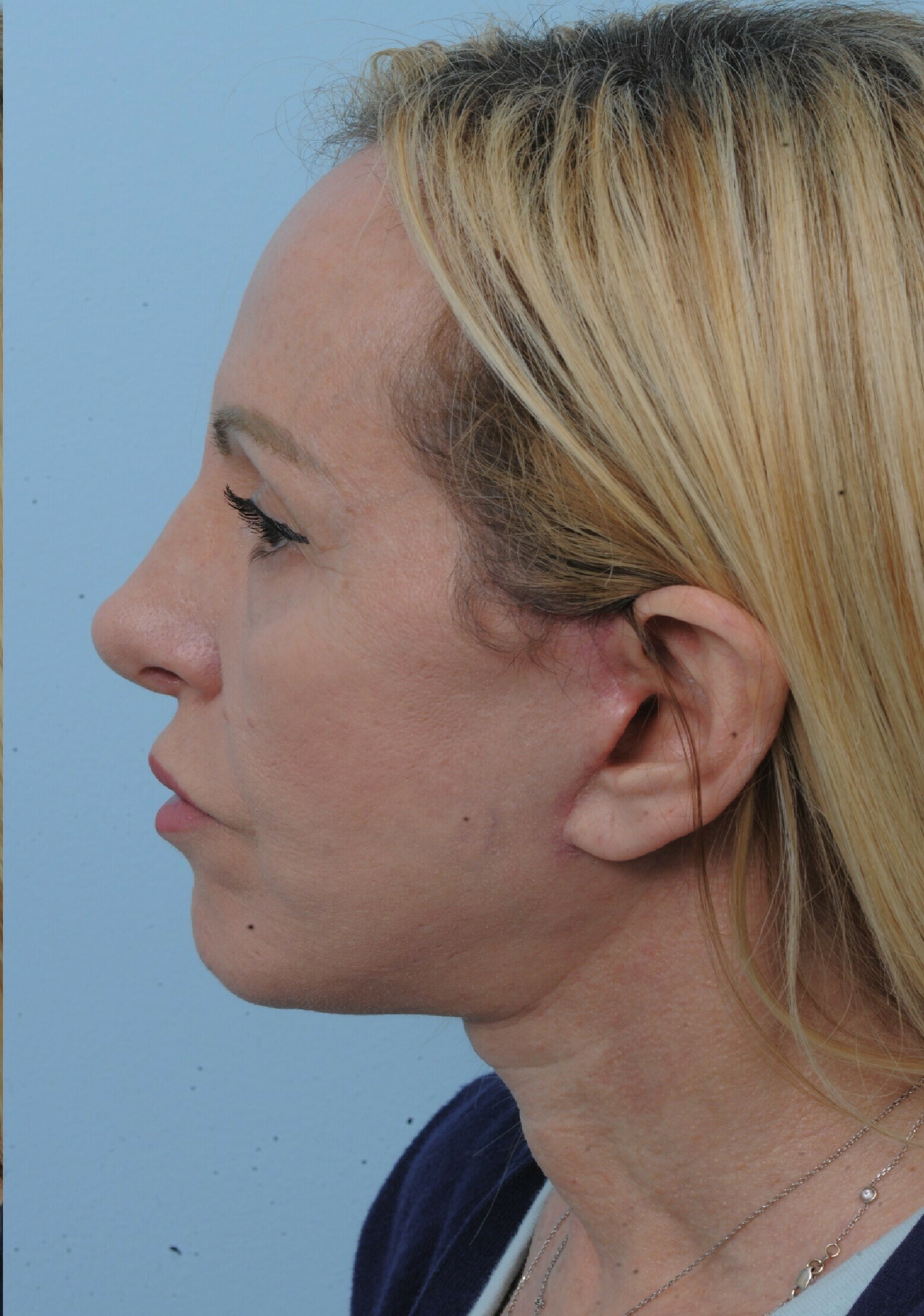 Photo of the patient’s face after the Facelift surgery. Set 2. Patient 6