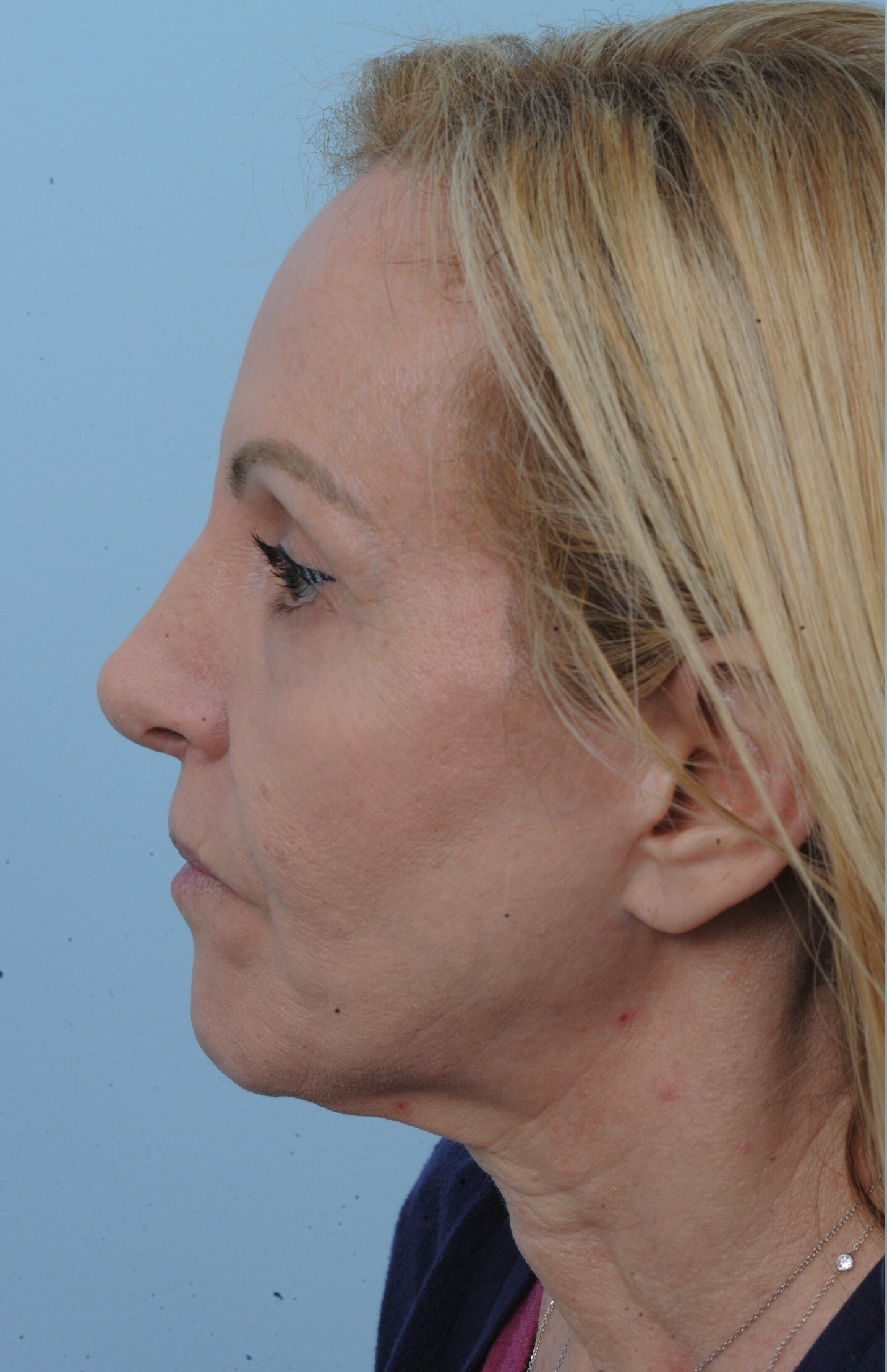 Photo of the patient’s face before the Facelift surgery. Set 2. Patient 6