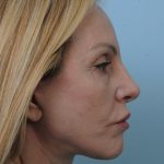 Photo of the patient’s face after the Facelift surgery. Set 3. Patient 6