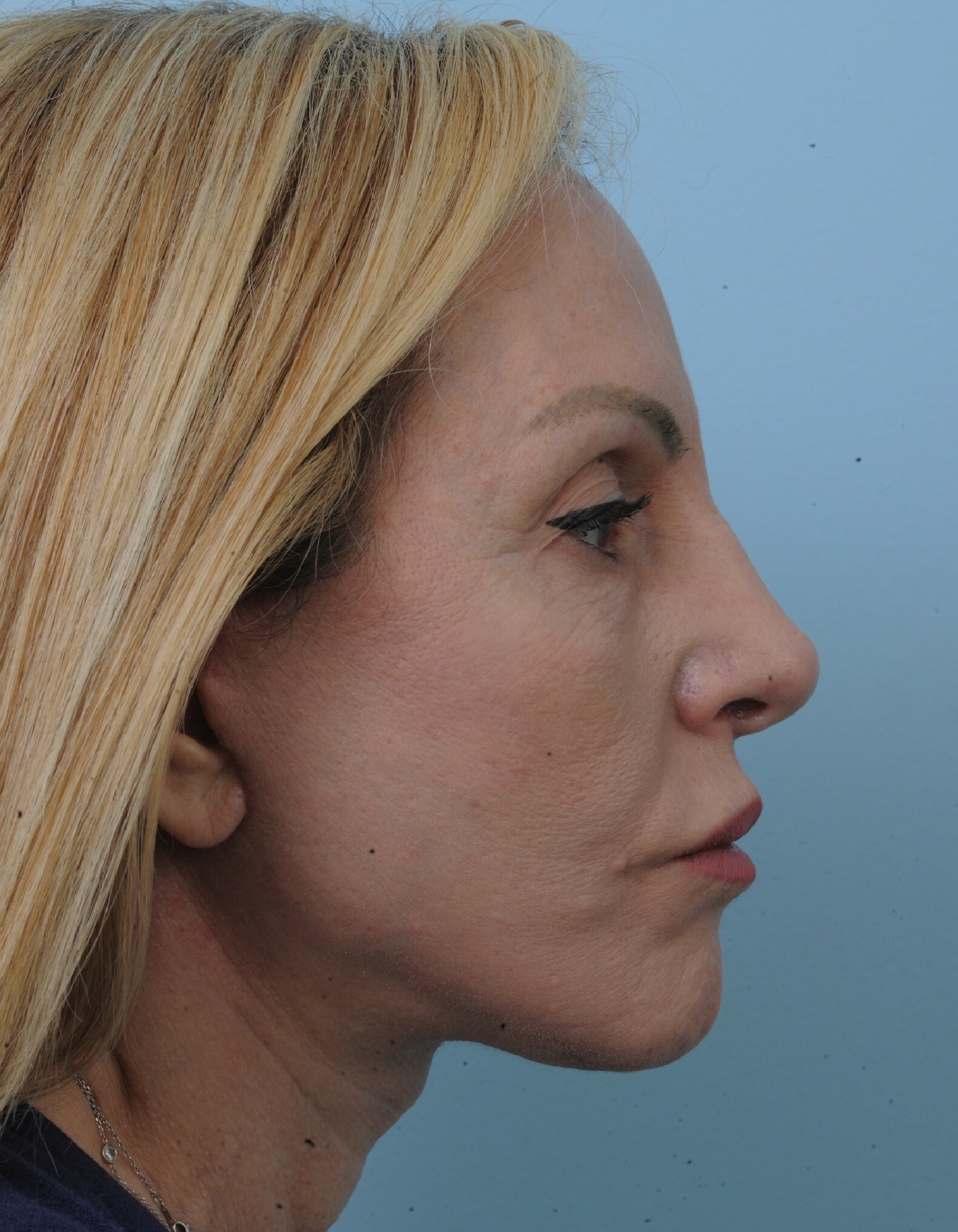 Photo of the patient’s face after the Facelift surgery. Set 3. Patient 6