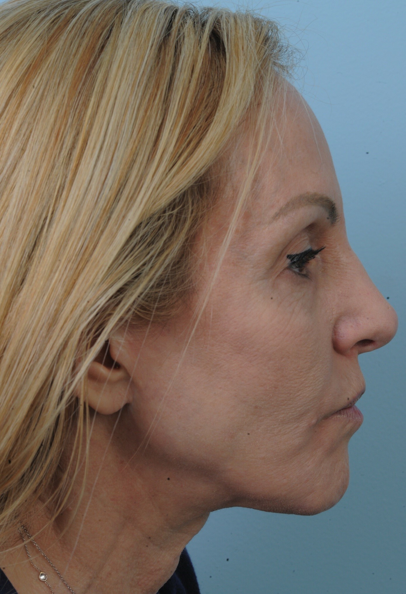 Photo of the patient’s face before the Facelift surgery. Set 3. Patient 6