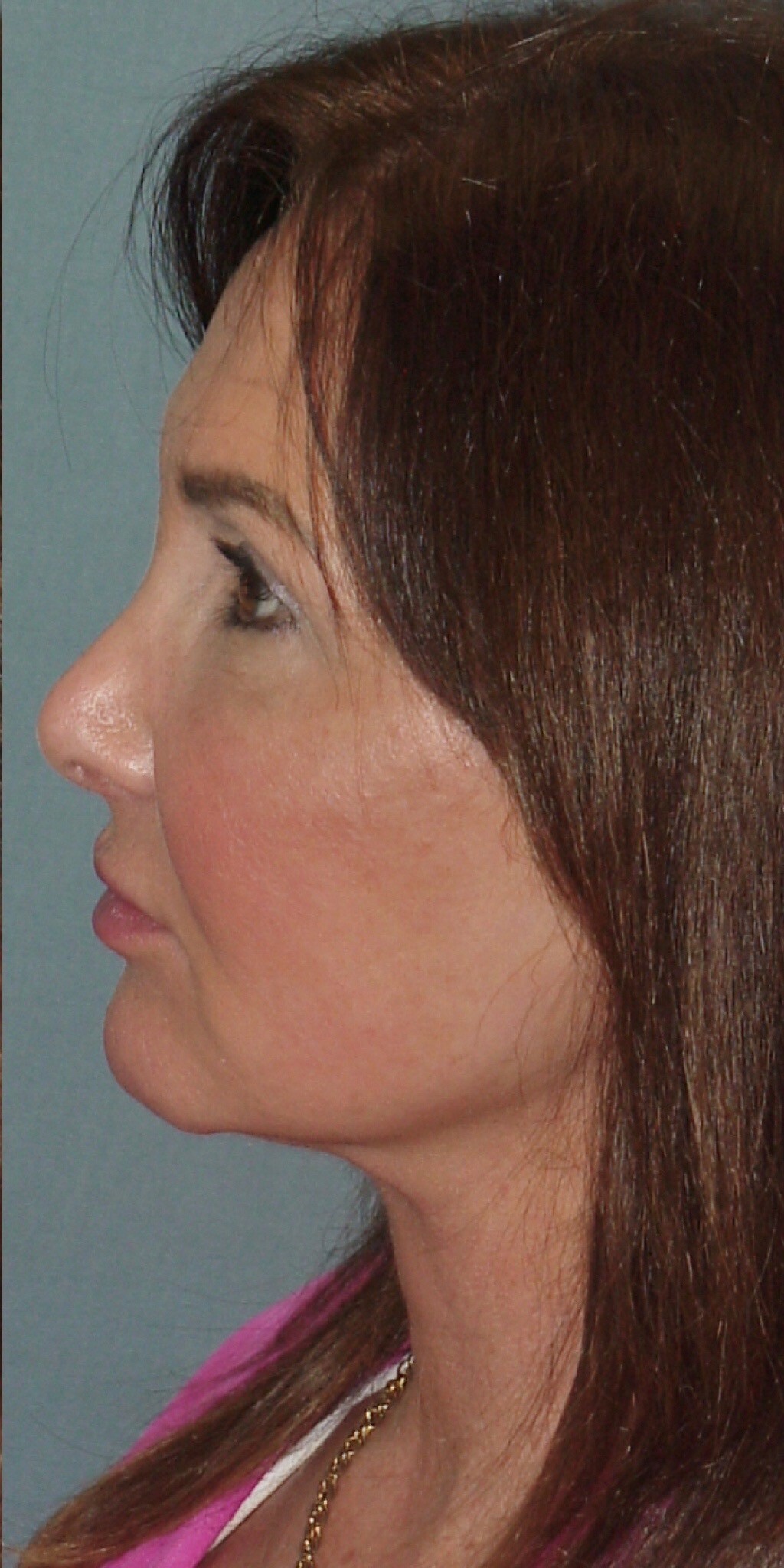 Photo of the patient’s face after the Facelift surgery. Set 3. Patient 7