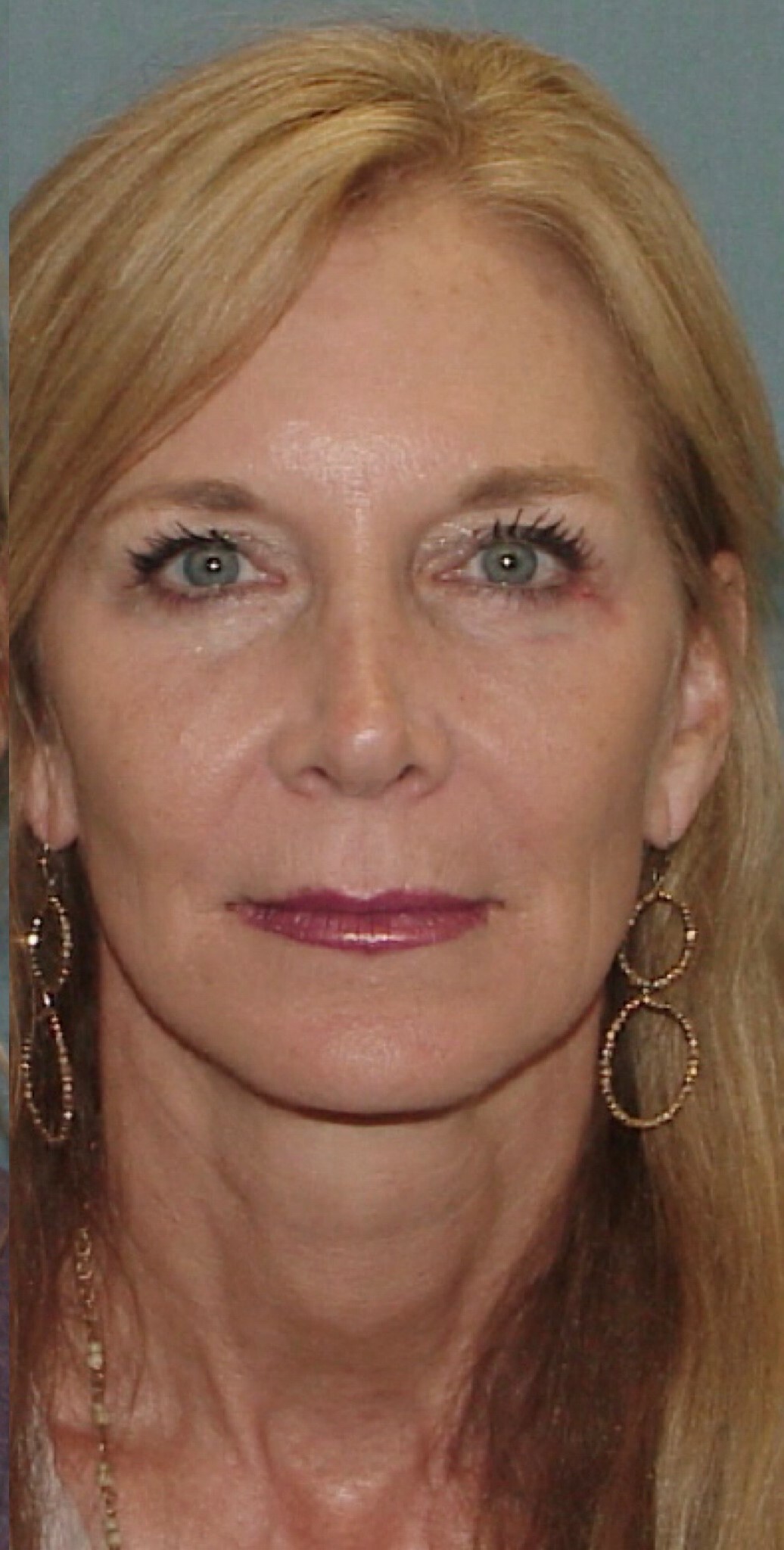Photo of the patient’s face after the Facelift surgery. Set 1. Patient 1