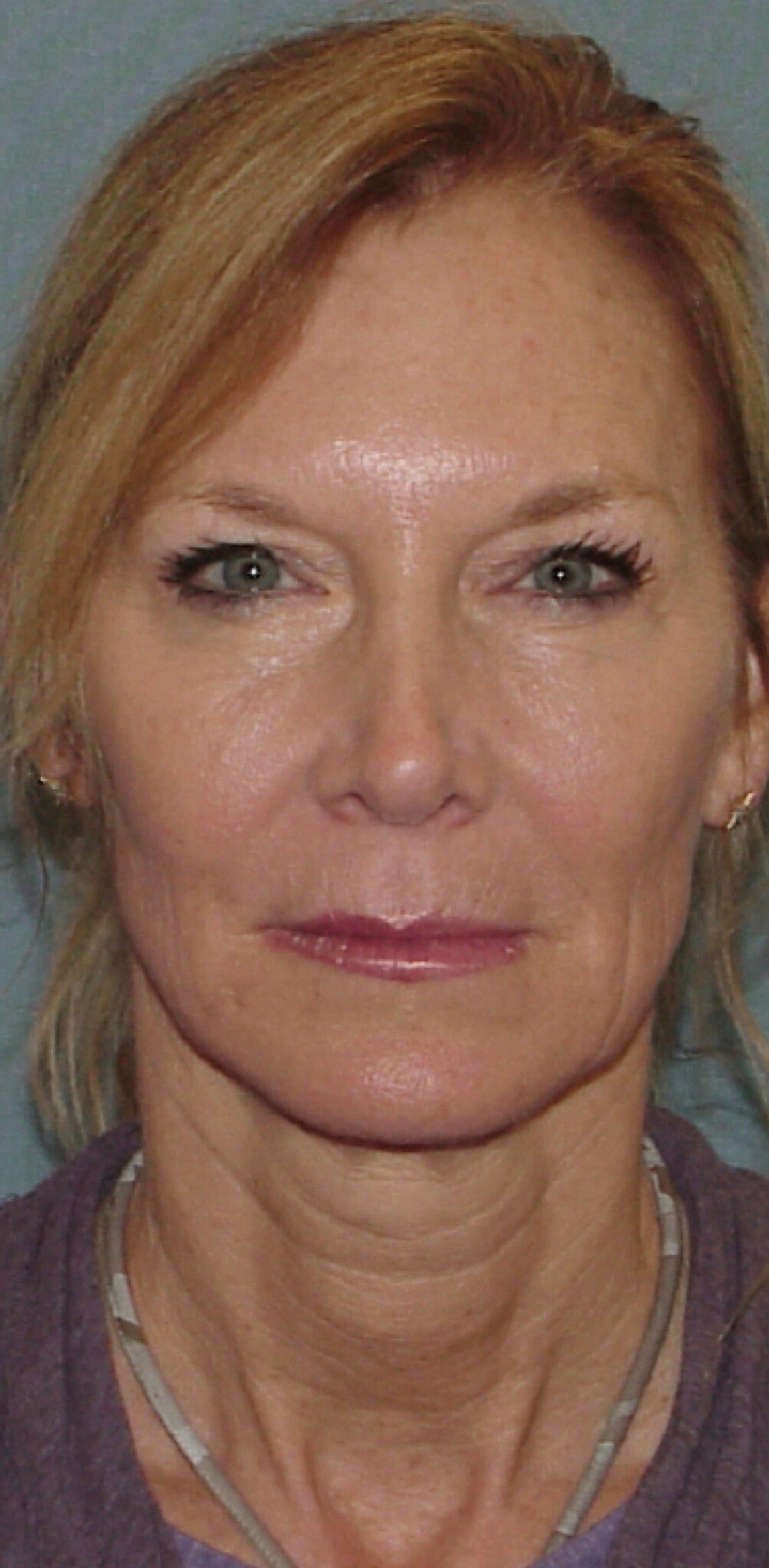 Photo of the patient’s face before the Facelift surgery. Set 1. Patient 1