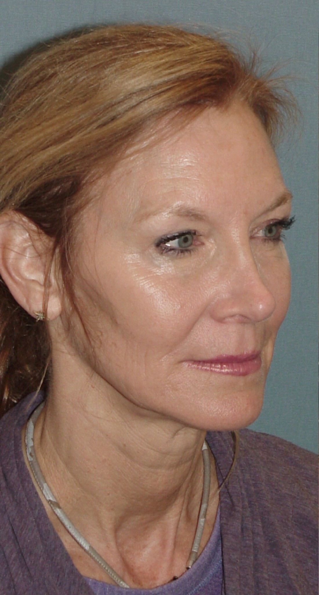Photo of the patient’s face before the Facelift surgery. Set 2. Patient 1