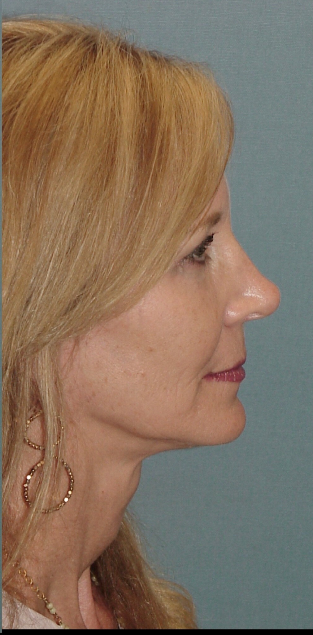 Photo of the patient’s face after the Facelift surgery. Set 3. Patient 1
