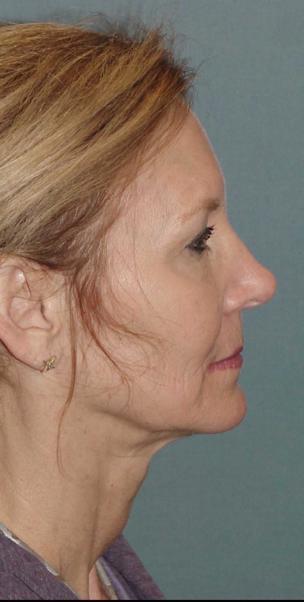 Photo of the patient’s face before the Facelift surgery. Set 3. Patient 1